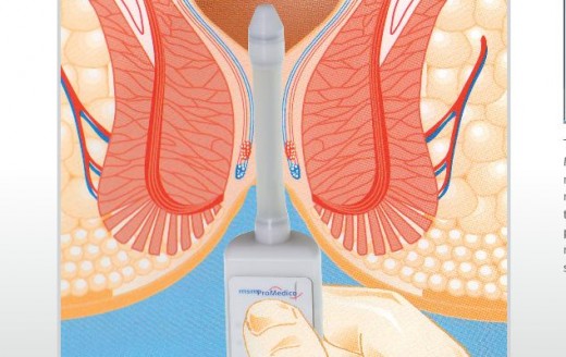 SPHINCTOMETER